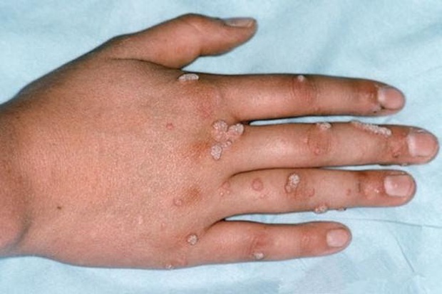 Người đàn ông dương tính với HPV, bác sĩ nhắc nhở: nên tránh một nơi, hai vật dụng không nên sử dụng chung - Ảnh 2. Người đàn ông dương tính với HPV, bác sĩ nhắc nhở: nên tránh một nơi, hai vật dụng không nên sử dụng chung - Ảnh 2.