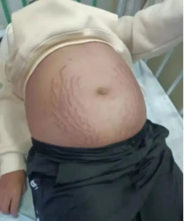 Nữ sinh 13 tuổi bụng nổi đầy vết rạn da và phình to như đang mang thai tháng thứ 8, kết quả xét nghiệm khiến ai cũng bất ngờ - Ảnh 1.