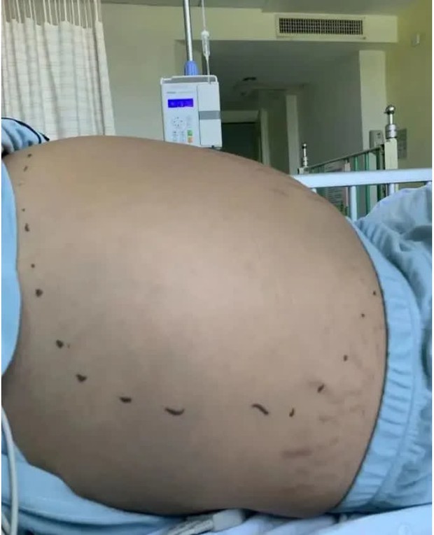 Nữ sinh 13 tuổi bụng nổi đầy vết rạn da và phình to như đang mang thai tháng thứ 8, kết quả xét nghiệm khiến ai cũng bất ngờ - Ảnh 3.