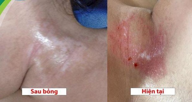Bé gái 19 tháng tuổi bỏng nặng vì lọ dung dịch hầu hết nhà nào cũng có - Ảnh 2.