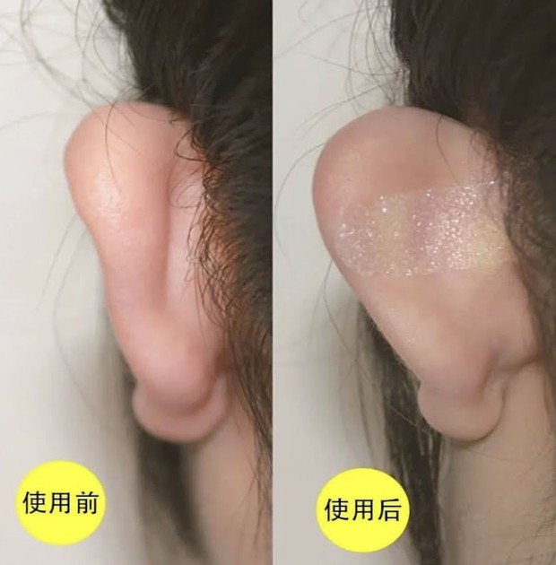 Bình luận trái chiều về trào lưu thẩm mỹ tai yêu tinh - Ảnh 4.