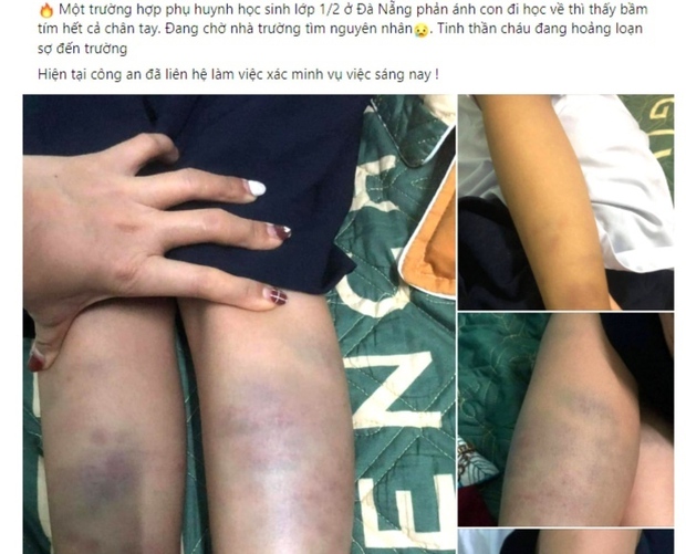 Học sinh lớp 1 bị đánh bầm tím chân tay: Công an TP Đà Nẵng vào cuộc - Ảnh 1.