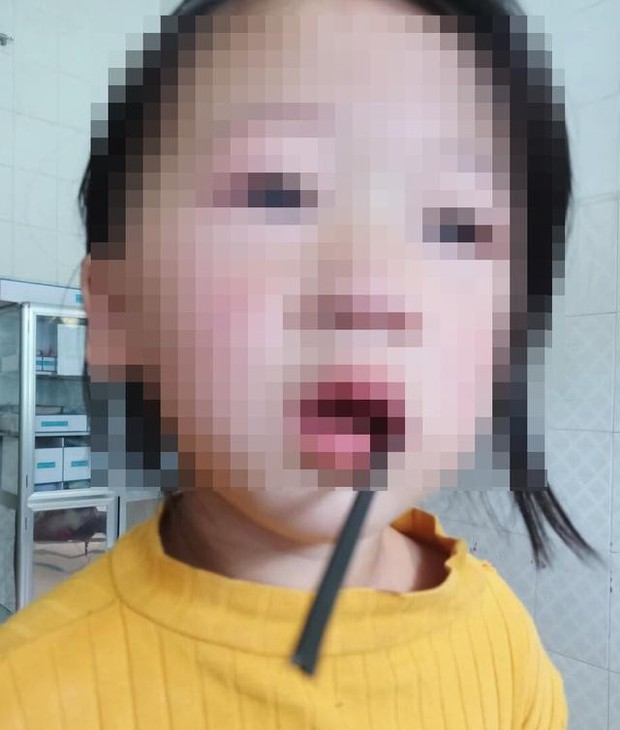 Bé gái 4 tuổi bị thanh sắt dài 20cm đâm vào khoang miệng - Ảnh 1. Bé gái 4 tuổi bị thanh sắt dài 20cm đâm vào khoang miệng - Ảnh 1.