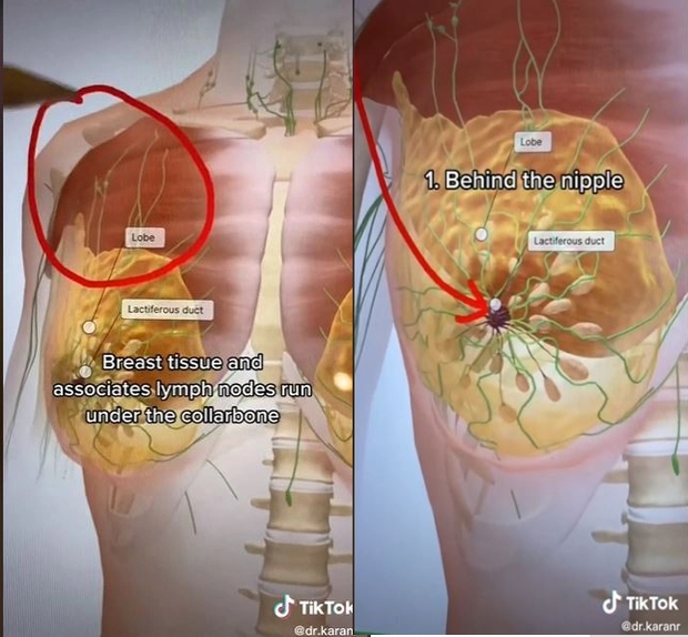 Bác sĩ cảnh báo về những điểm mù trong kiểm tra ung thư vú tại nhà thường bị bỏ qua - Ảnh 2.