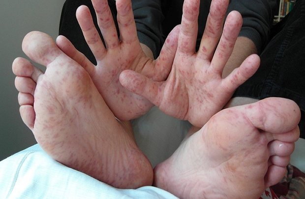 5 bất thường ở bàn tay cho thấy bệnh suy thận đã tấn công cơ thể - Ảnh 3.