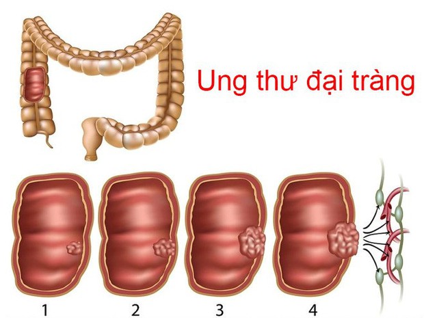 Ung thư ruột kết mà vua bóng đá Pele mắc nguy hiểm thế nào, cách phát hiện và phòng ngừa? - Ảnh 2. Ung thư ruột kết mà vua bóng đá Pele mắc nguy hiểm thế nào, cách phát hiện và phòng ngừa? - Ảnh 2.