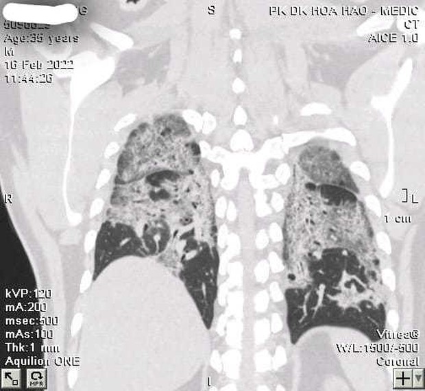F0 không có triệu chứng, phổi vẫn trắng xoá hậu Covid-19 - Ảnh 1.
