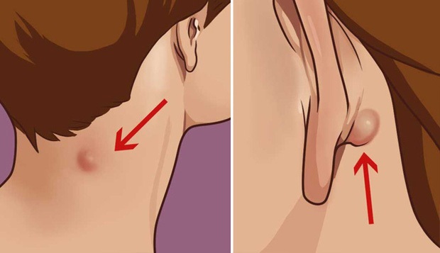 Đừng bỏ qua 4 biểu hiện bất thường trên da vì nó có thể là dấu hiệu sớm của bệnh ung thư - Ảnh 4. Đừng bỏ qua 4 biểu hiện bất thường trên da vì nó có thể là dấu hiệu sớm của bệnh ung thư - Ảnh 4.
