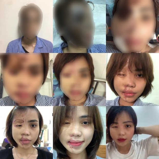 Cô gái bị chồng sắp cưới tạt axit 3 năm trước: Đã đi du học và trải qua 21 ca phẫu thuật - Ảnh 5. Cô gái bị chồng sắp cưới tạt axit 3 năm trước: Đã đi du học và trải qua 21 ca phẫu thuật - Ảnh 5.