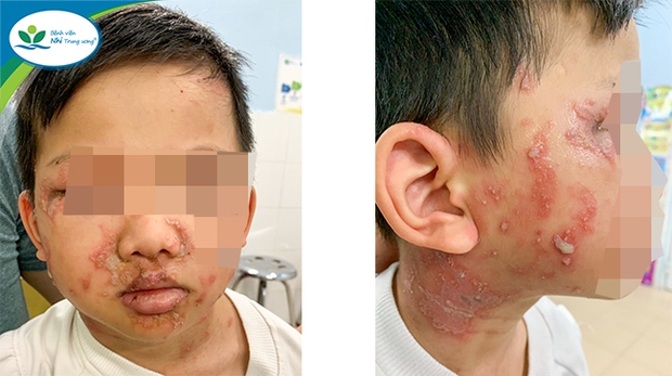 A 5-year-old boy has contact dermatitis caused by three-cavity ants, the doctor warns of the dangers - Photo 1.