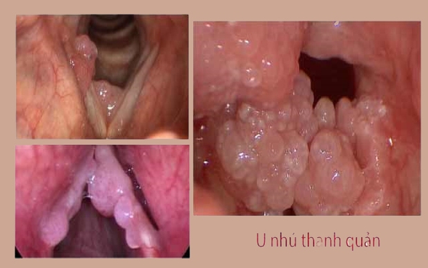 Nữ sinh 14 tuổi sống 10 năm với hàng trăm khối u súp lơ bịt kín trong cổ họng, giọng nói khàn đặc chỉ vì chủ quan với dấu hiệu nhiễm virus HPV - Ảnh 2. Nữ sinh 14 tuổi sống 10 năm với hàng trăm khối u súp lơ bịt kín trong cổ họng, giọng nói khàn đặc chỉ vì chủ quan với dấu hiệu nhiễm virus HPV - Ảnh 2.
