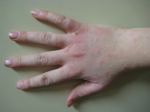 4 biểu hiện bất thường ở ngón tay giữa ngầm cảnh báo gan đang bị tổn thương, mong rằng bạn không gặp bất kỳ điều nào - Ảnh 4.