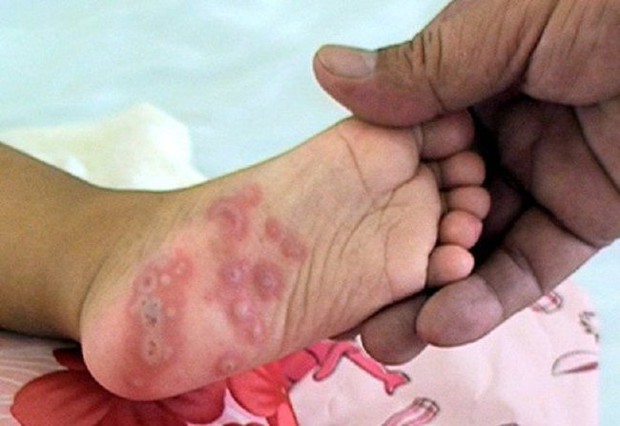 Taking care of children with hand, foot and mouth disease at home: 5 most important things to do for your child to get well quickly - Photo 4.