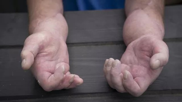 Người mắc bệnh xơ cứng bì được ghép cả hai bàn tay đầu tiên trên thế giới tại Anh - Ảnh 2.