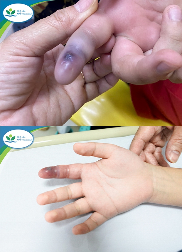 Hà Nội: Lén nuôi rắn lục đuôi đỏ làm thú cưng, bé trai 13 tuổi bị cắn nguy hiểm tính mạng