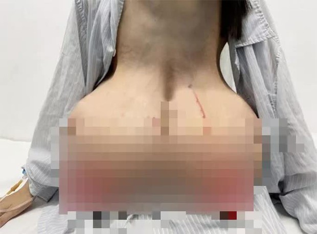 Nữ sinh 12 tuổi đi lại khó khăn vì ngực khủng - Ảnh 1.