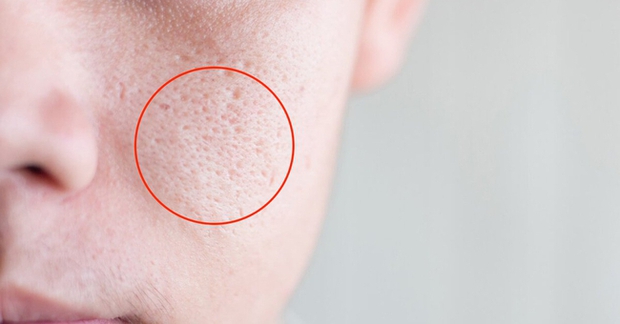 Bước làm sạch đặc biệt giúp chị em cải thiện rõ tình trạng lỗ chân lông to ngoác trên da - Ảnh 1.