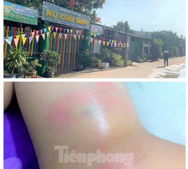Bé gái 4 tuổi nghi bị cô giáo đánh bầm tím vì đi vệ sinh trong quần - Ảnh 1. Bé gái 4 tuổi nghi bị cô giáo đánh bầm tím vì đi vệ sinh trong quần - Ảnh 1.