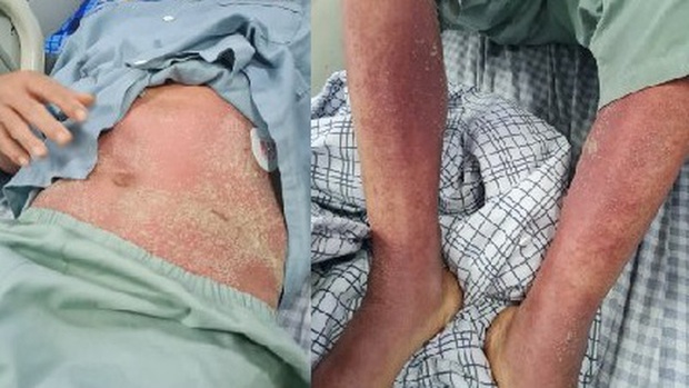 2 bệnh nhân bị viêm màng não, nhiễm khuẩn huyết do liên cầu lợn - Ảnh 1. 2 bệnh nhân bị viêm màng não, nhiễm khuẩn huyết do liên cầu lợn - Ảnh 1.