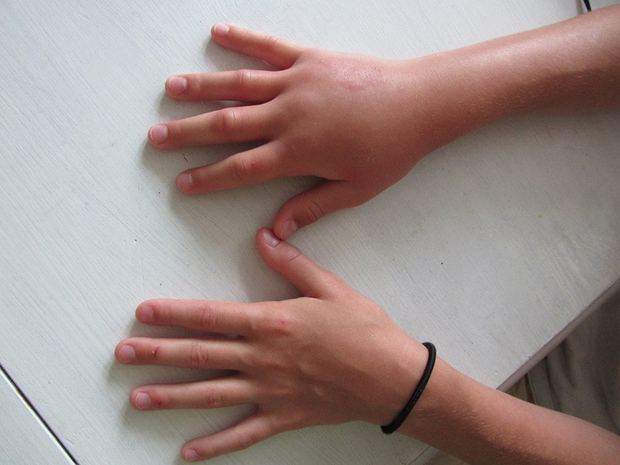 6 dấu hiệu trên bàn tay đang ám chỉ rằng lượng đường trong máu đã quá cao nhưng hầu hết chúng ta đều xem nhẹ - Ảnh 4.