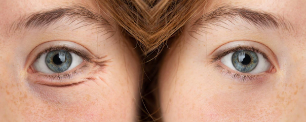 5 cách khắc phục quầng thâm dưới mắt hiệu quả tại nhà - Ảnh 1.