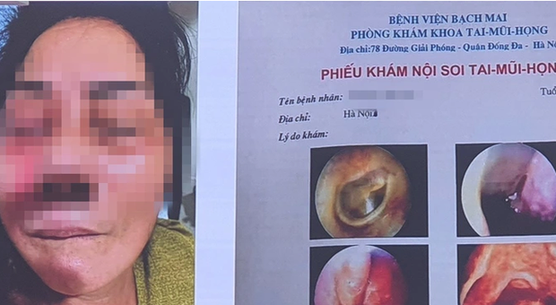 Hà Nội ghi nhận 3 ca hoại tử xương hàm - Ảnh 1. Hà Nội ghi nhận 3 ca hoại tử xương hàm - Ảnh 1.