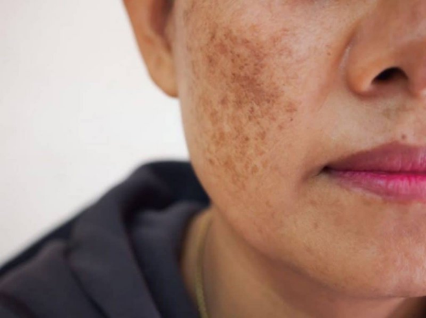 Tổng quan về nám da: Nguyên nhân, điều trị và biện pháp phòng ngừa - Ảnh 1. Tổng quan về nám da: Nguyên nhân, điều trị và biện pháp phòng ngừa - Ảnh 1.