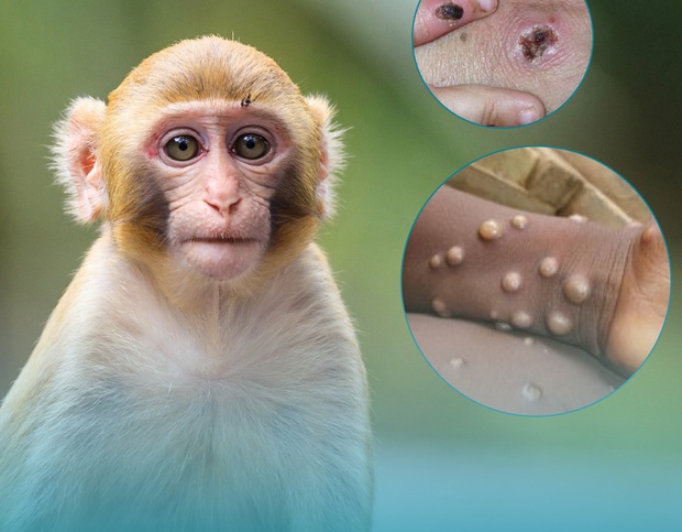 Nóng: Bộ Y tế ban hành hướng dẫn chẩn đoán, điều trị và phòng bệnh đậu mùa khỉ ở người - Ảnh 1. Nóng: Bộ Y tế ban hành hướng dẫn chẩn đoán, điều trị và phòng bệnh đậu mùa khỉ ở người - Ảnh 1.