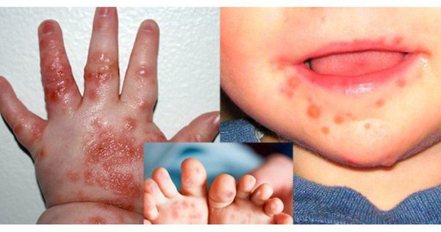 Trẻ có thể bị tay chân miệng và sốt xuất huyết cùng lúc không? Phân biệt vết loét do tay chân miệng gây ra - Ảnh 1.