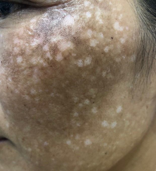 Nhiễm độc corticoid, da mỏng tang sau khi bôi kem trộn chữa nám - Ảnh 2.