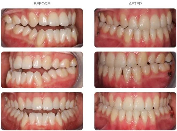 Chuyên gia chỉ ra 6 trường hợp cần phải niềng răng và đây là tầm quan trọng của việc lựa chọn phương pháp phù hợp - Ảnh 2.
