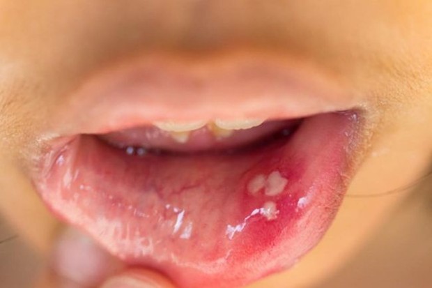 Lưỡi bỗng xuất hiện đốm trắng có thể là dấu hiệu của 3 thứ bệnh, đặc biệt là loại ung thư nguy hiểm này - Ảnh 4.