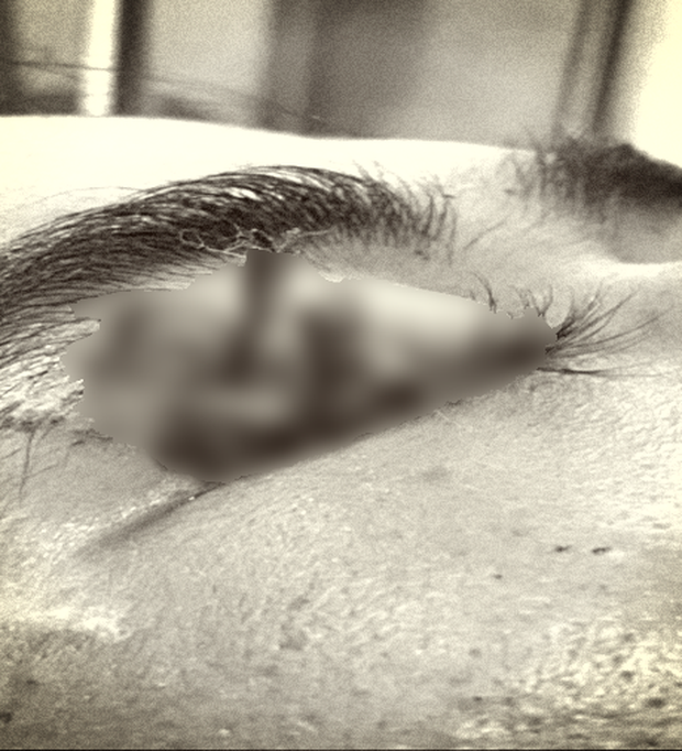 Cứu bệnh nhân nhập viện với cây đũa tre cắm sâu vào hốc mắt - Ảnh 2.