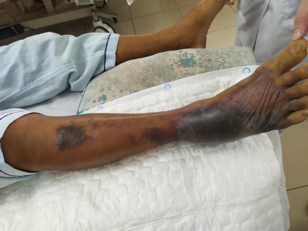 Hoại tử chân, nhiễm khuẩn huyết do nhiễm vi khuẩn Vibrio vulnificus - Ảnh 2.