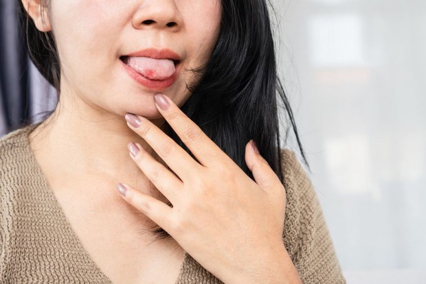 Phát hiện bất thường ở lưỡi, người phụ nữ được chẩn đoán ung thư vú đã di căn, bác sĩ hướng dẫn 3 bước tự kiểm tra - Ảnh 1. Phát hiện bất thường ở lưỡi, người phụ nữ được chẩn đoán ung thư vú đã di căn, bác sĩ hướng dẫn 3 bước tự kiểm tra - Ảnh 1.