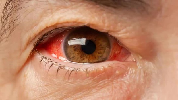 11 dấu hiệu ở mắt cảnh báo ung thư, dù có một trong số đó cũng phải đi khám ngay - Ảnh 2. 11 dấu hiệu ở mắt cảnh báo ung thư, dù có một trong số đó cũng phải đi khám ngay - Ảnh 2.