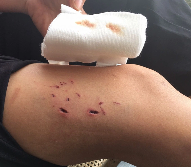 Bé gái 7 tuổi bị tấn công bởi 4 con chó, BV Nhi cảnh báo nguy cơ bệnh dại