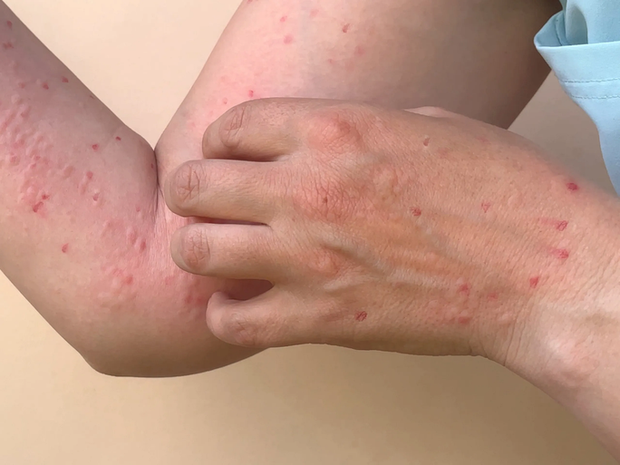 56 ca nhiễm đậu mùa khỉ được ghi nhận tại 7 địa phương