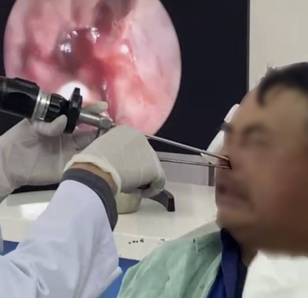 Gắp hơn 100 con giòi làm tổ trong hốc mũi bệnh nhân 53 tuổi - Ảnh 1.