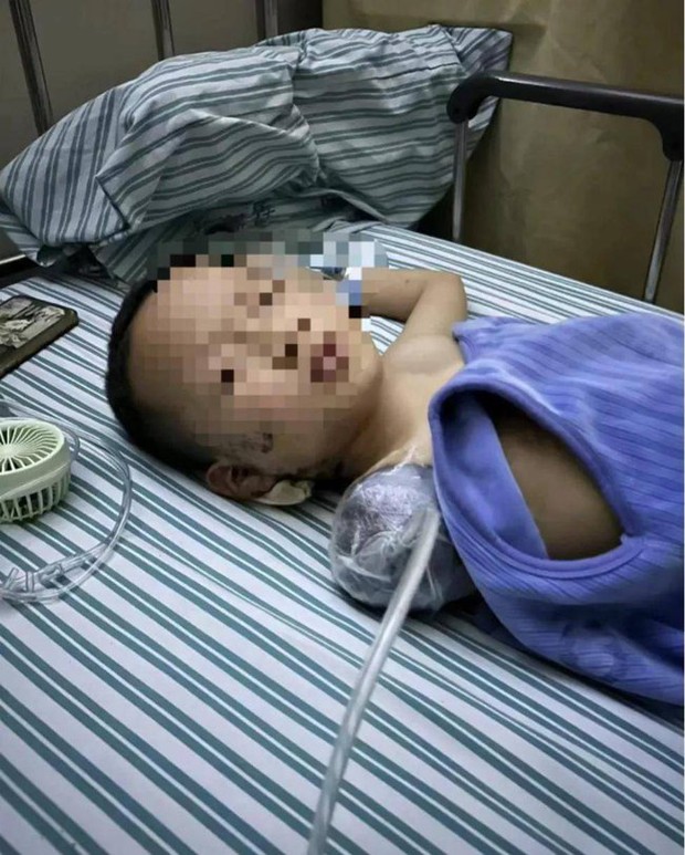 Mẹ ơi, con đau chết mất - cậu nhóc 7 tuổi đang chơi trước nhà thì gặp sự cố phải cắt cụt 1 tay, bóng ma tâm lý đi theo suốt đời vì sai lầm của hàng xóm - Ảnh 1.