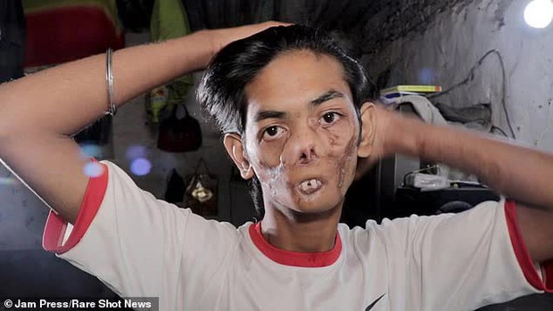 Bị sói tấn công từ khi còn nhỏ, chàng trai 18 tuổi bị dân làng xa lánh, gọi là cậu bé ma vì ngoại hình biến dạng khiến nhiều người xót xa - Ảnh 2.