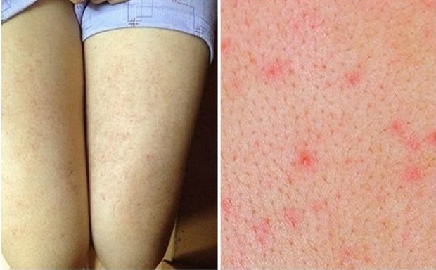 Cô nàng loại bỏ viêm nang lông, da sần sùi ngay tại nhà với combo sữa tắm + lotion body - Ảnh 1. Cô nàng loại bỏ viêm nang lông, da sần sùi ngay tại nhà với combo sữa tắm + lotion body - Ảnh 1.