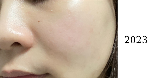 Tuân thủ 3 tips skincare, cô nàng giữ làn da láng mịn không mụn suốt 4 năm - Ảnh 2.