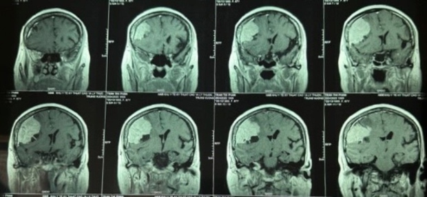 Đi khám đau đầu, phát hiện khối u màng não to hơn quả trứng - Ảnh 1.