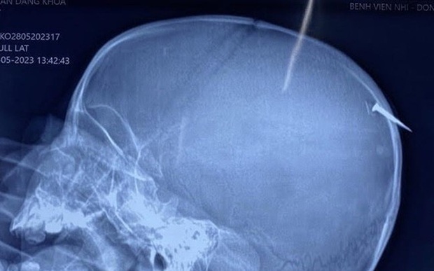 Phẫu thuật kịp thời cho bé trai bị cây đinh dài 3cm đâm qua xương sọ - Ảnh 1.