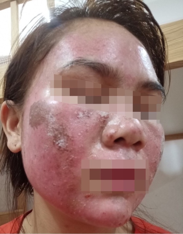 Không sợ đau rát, chỉ sợ da không sáng sau khi thăm spa