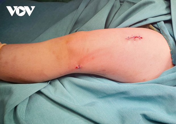 Cứu sống bé trai 3 tuổi: Chiếc quạt nuôi tôm đã trở thành ác mộng