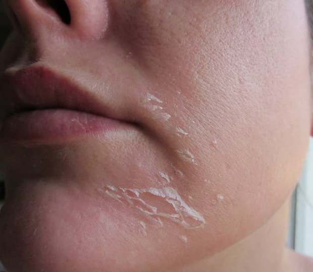 Peel da vào mùa hè để tăng sinh collagen: Chuyên gia khuyến cáo những lưu ý quan trọng - Ảnh 1.