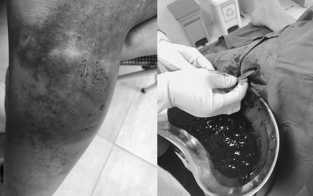 Cảnh báo: Mật gấu xoa bóp không đúng cách khi gặp chấn thương phần mềm