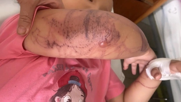 Bị sứa đốt khi tắm biển, bé 7 tuổi nhập viện trong tình trạng mất ý thức - Ảnh 2.